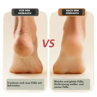 Foot Care Device | Rechargeable | Easy Operation | Plastic